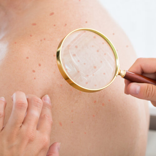 An Overview Of Cellulitis