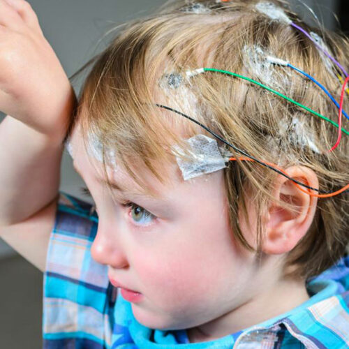 Seizures – Symptoms and Treatment